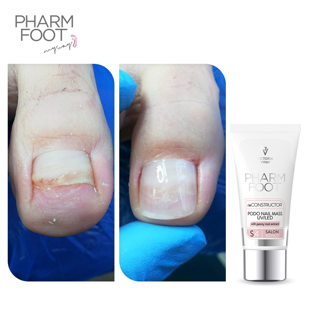 PHARM FOOT Nail reconstructor, reConstructor Podo Nail Set UV/LED