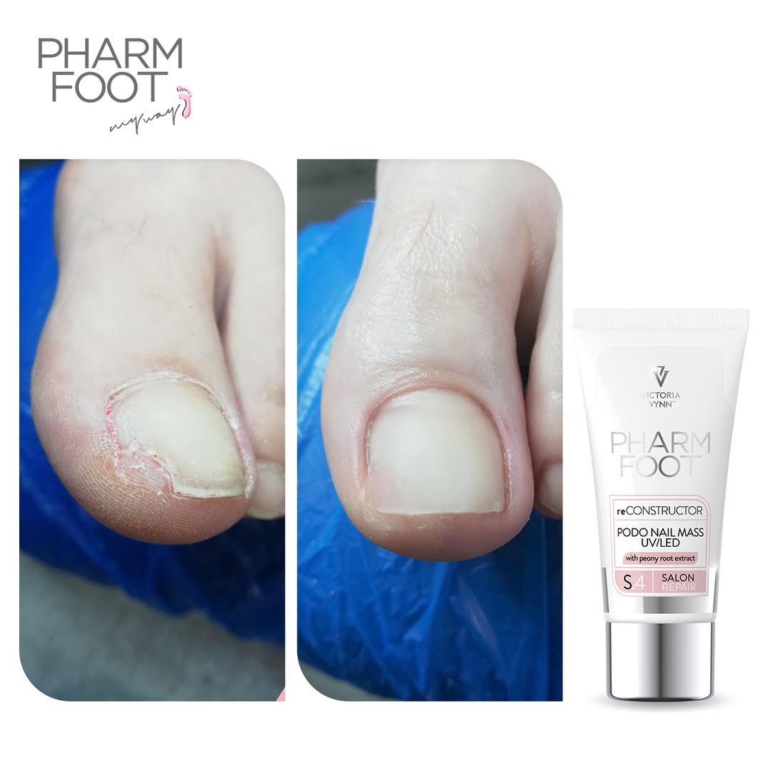 PHARM FOOT Nail reconstructor, reConstructor Podo Nail Set UV/LED