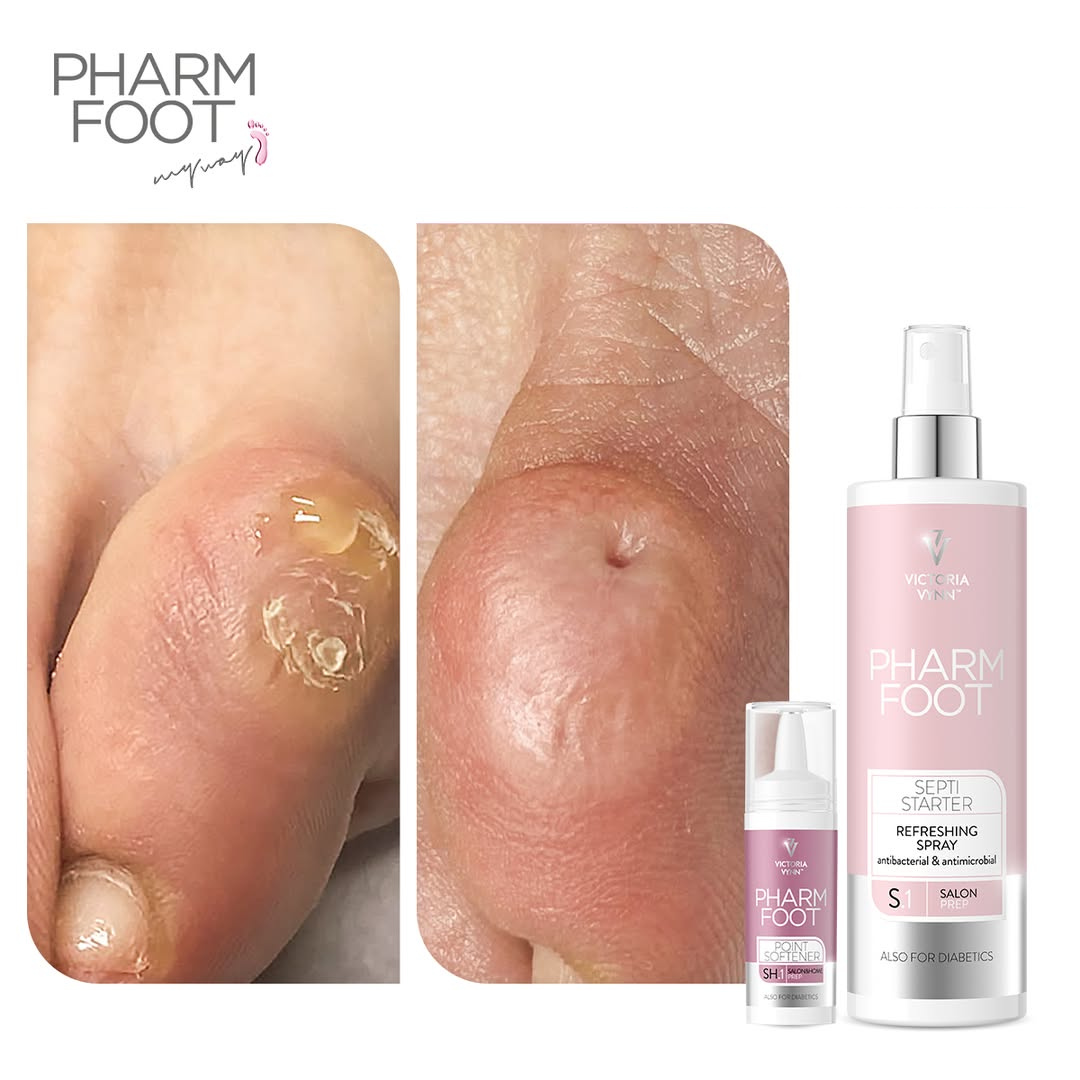 PHARM FOOT Komplektas nagų įtvarų nuėmimui