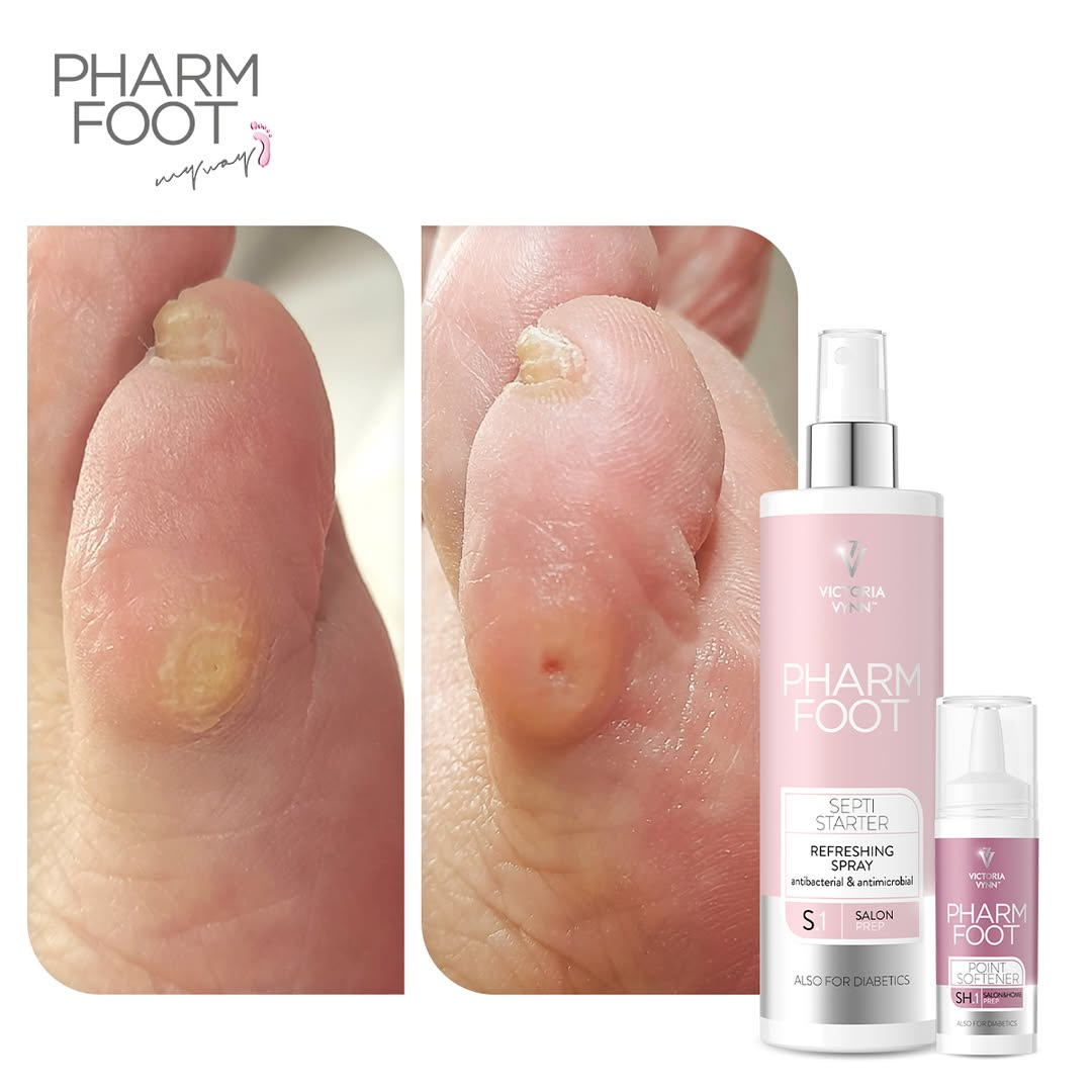 PHARM FOOT Komplektas nagų įtvarų nuėmimui